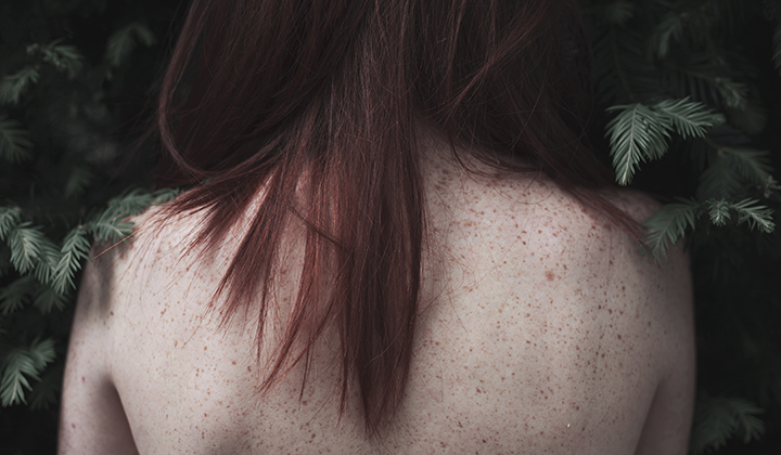画像：女性の背中のシミ