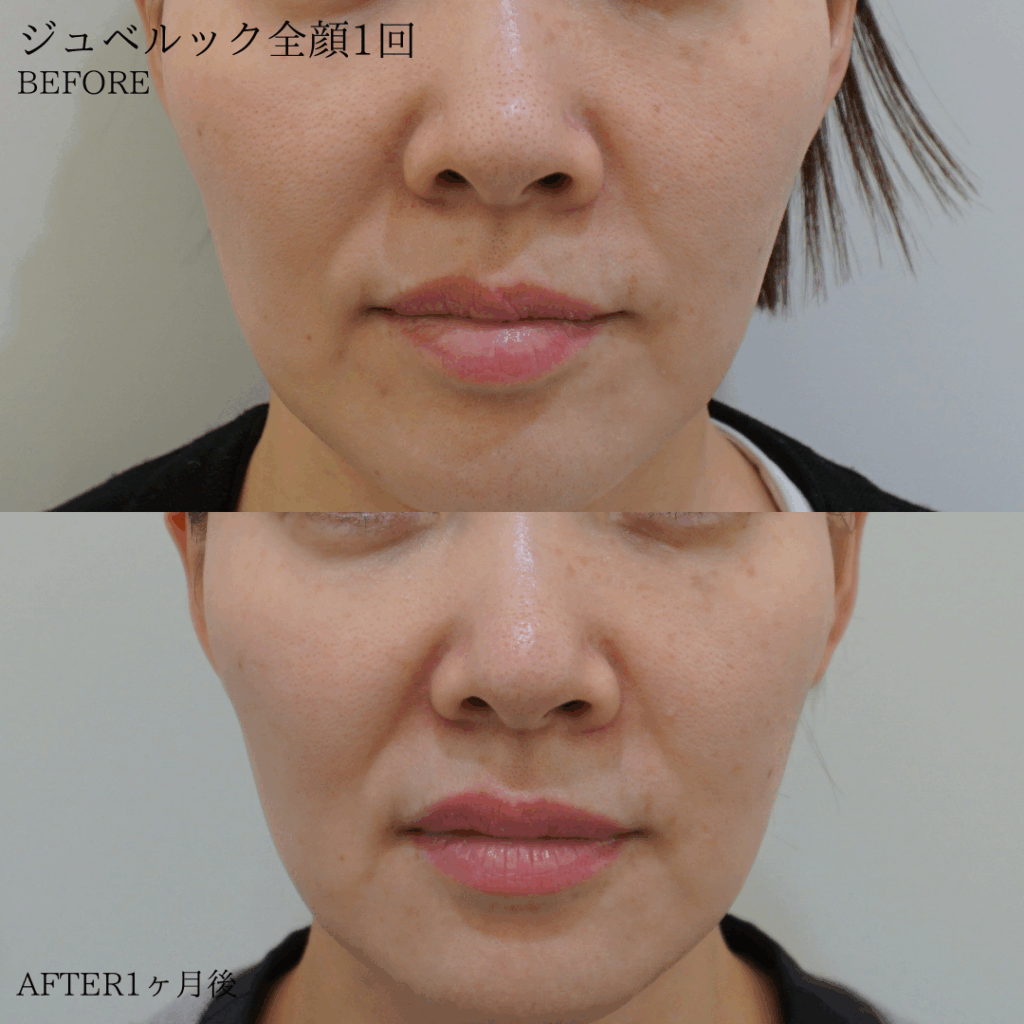 case-pores20250728-1