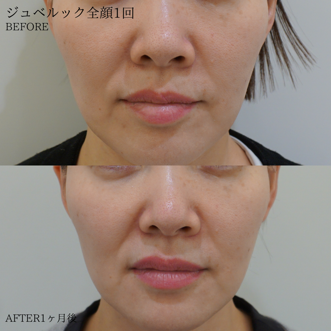 case-pores20250728-1
