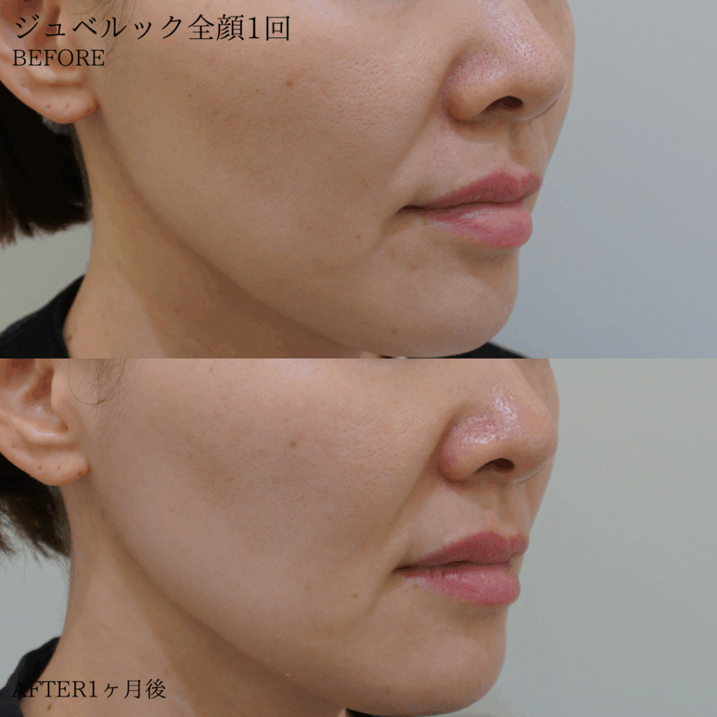 case-pores20250728-2