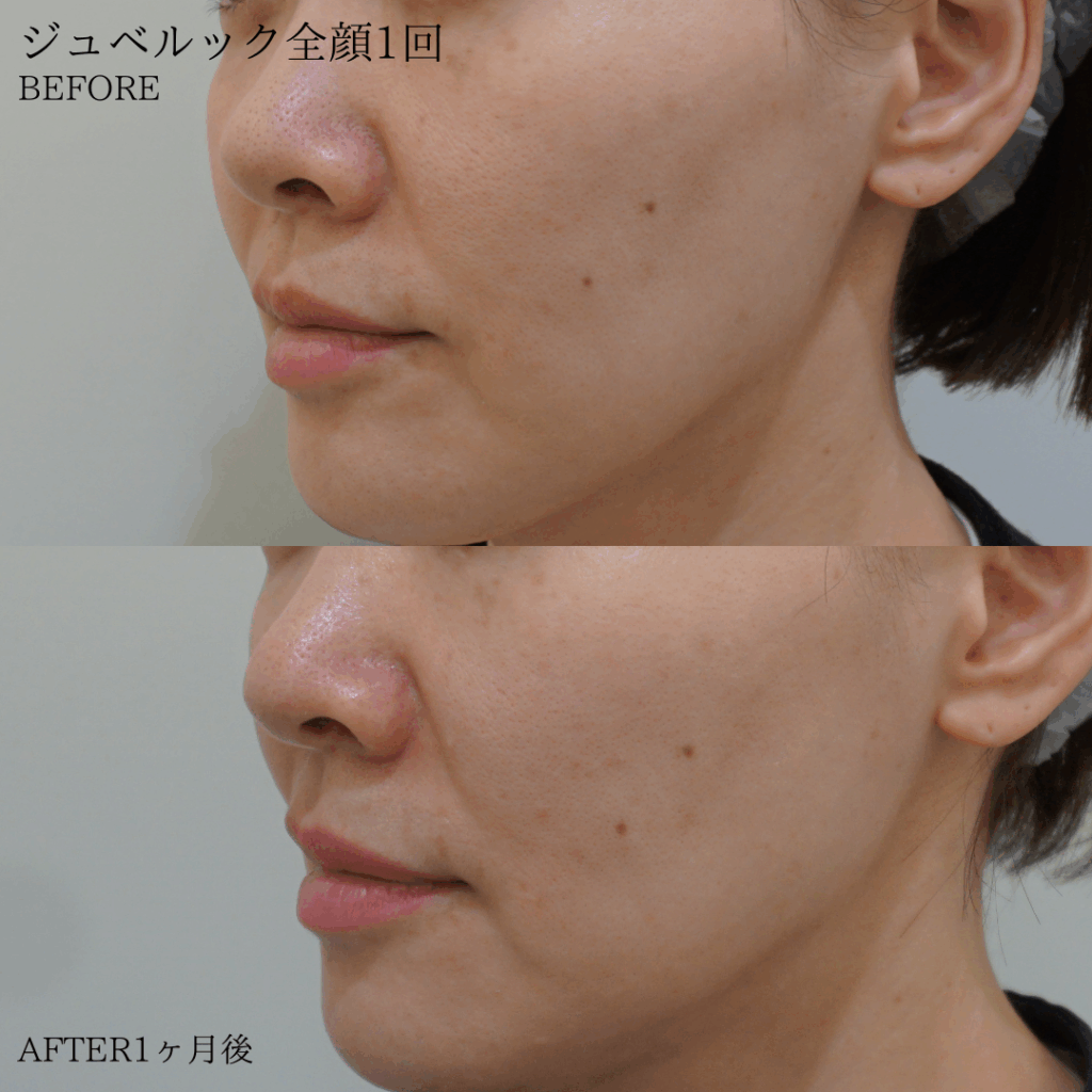 case-pores20250728-3