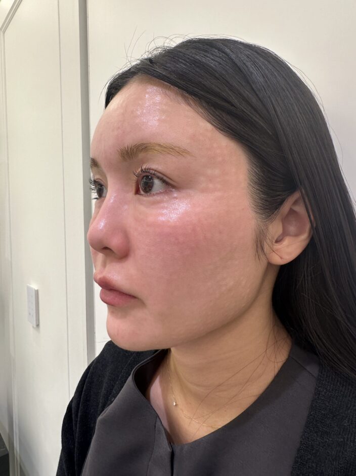 ハイコックスで「漏れない」水光注射が選ばれる理由【キャンペーン実施中】