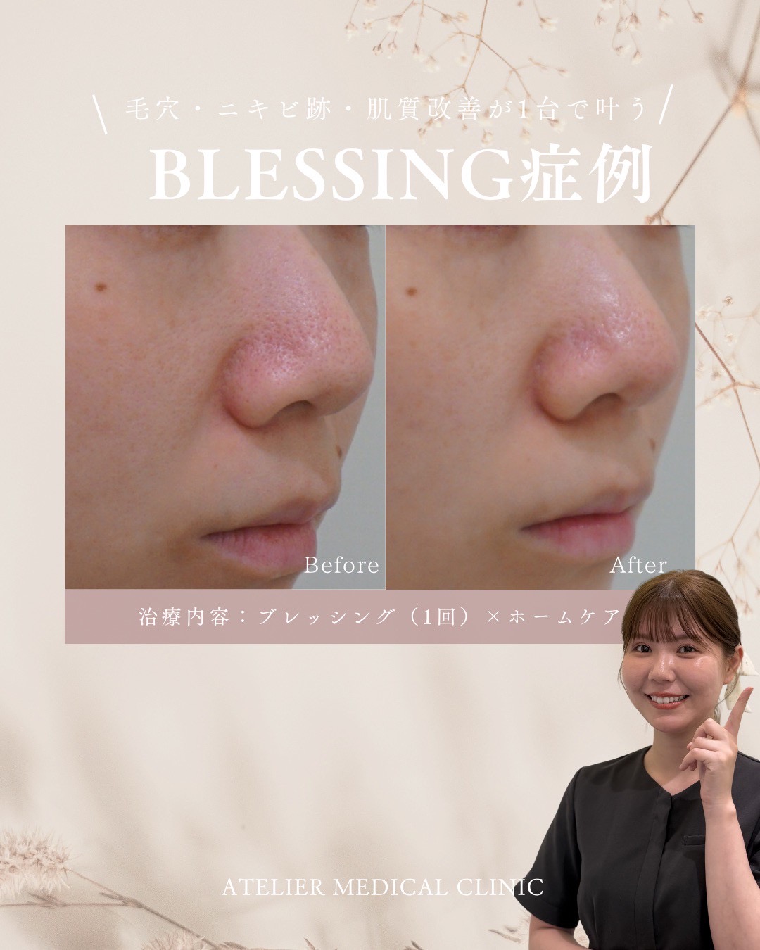 「毛穴をゼロにしたい」は叶う？美容医療のリアルと、目立たなくさせる方法